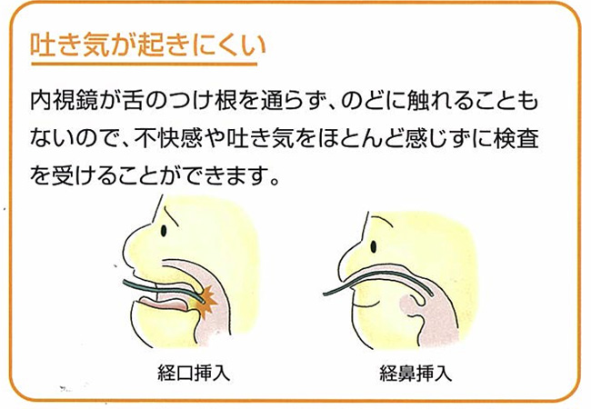 吐き気が起きにくい